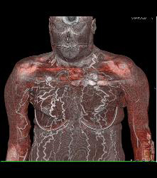 SVC Occlusion With Extensive Collaterals in Chest Wall - CTisus CT Scan