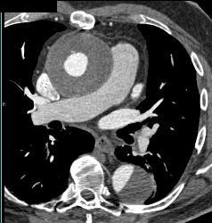 Root Repair With Aortic Dissection - CTisus CT Scan