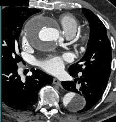 Root Repair With Aortic Dissection - CTisus CT Scan