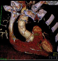 Root Repair With Aortic Dissection - CTisus CT Scan