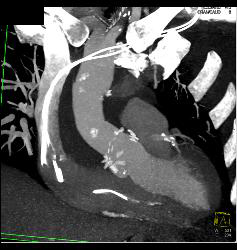 Root Repair With Aortic Dissection - CTisus CT Scan