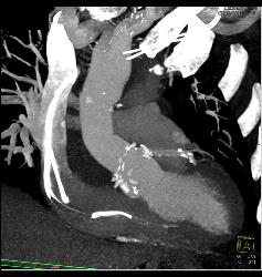 Root Repair With Aortic Dissection - CTisus CT Scan