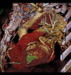 Root Repair With Aortic Dissection - CTisus CT Scan