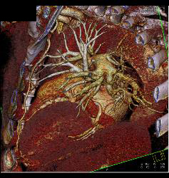 Root Repair With Aortic Dissection - CTisus CT Scan