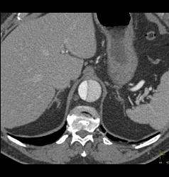 Type B Dissection - CTisus CT Scan