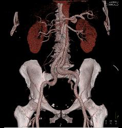 Type B Dissection - CTisus CT Scan