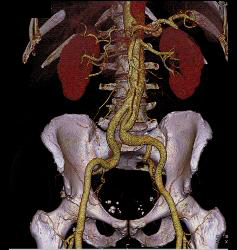 Type B Dissection - CTisus CT Scan