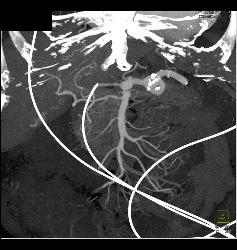 Type B Dissection - CTisus CT Scan