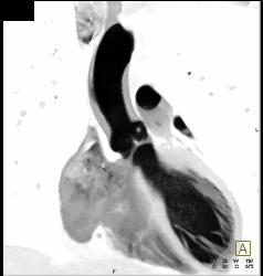 Small Fibroma on Aortic Valve Leaflet - CTisus CT Scan