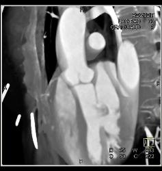 Small Fibroma on Aortic Valve Leaflet - CTisus CT Scan