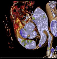 Small Fibroma on Aortic Valve Leaflet - CTisus CT Scan