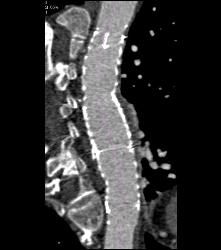 Endovascular Stent in Thoracic Aorta - CTisus CT Scan