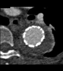 Endovascular Stent in Thoracic Aorta - CTisus CT Scan