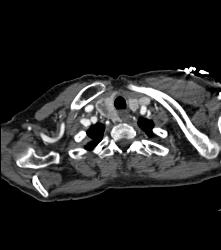 Thyroid Goiter - CTisus CT Scan