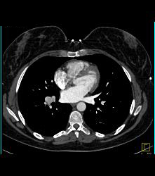 Thrombosed Right Pulmonary Artery - CTisus CT Scan