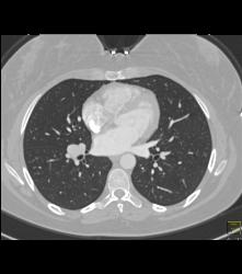 Dilated Bronchial Arteries - CTisus CT Scan