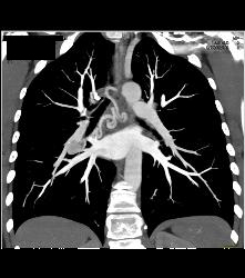 Dilated Bronchial Arteries - CTisus CT Scan