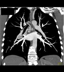 Dilated Bronchial Arteries - CTisus CT Scan