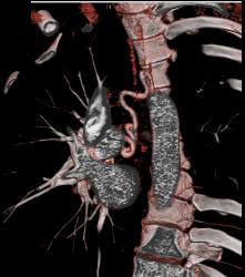 Dilated Bronchial Arteries - CTisus CT Scan