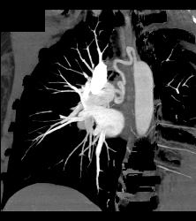 Dilated Bronchial Arteries - CTisus CT Scan