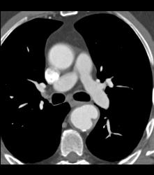 Ulceration in Descending Aorta - CTisus CT Scan