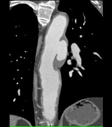 Ulceration in Descending Aorta - CTisus CT Scan