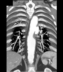 Ulceration in Descending Aorta - CTisus CT Scan