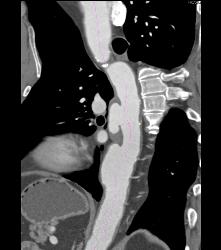 Ulceration in Descending Aorta - CTisus CT Scan