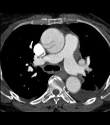 Type A Dissection - CTisus CT Scan