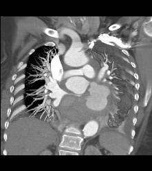 Pseudo-aneurysm Off Ascending Arch - CTisus CT Scan