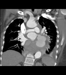 Pseudo-aneurysm Off Ascending Arch - CTisus CT Scan