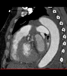 Pseudo-aneurysm Off Ascending Arch - CTisus CT Scan