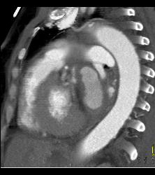 Pseudo-aneurysm Off Ascending Arch - CTisus CT Scan