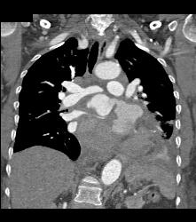 Pseudo-aneurysm Off Ascending Arch - CTisus CT Scan