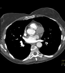 Pseudo-aneurysm Off Ascending Arch - CTisus CT Scan