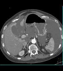 Carcinomatosis With Ascites and Prominent Mesenteric Vessels - CTisus CT Scan