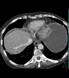 Carcinomatosis With Ascites and Prominent Mesenteric Vessels - CTisus CT Scan