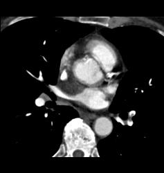 Pulmonary Embolism (PE) in Pulmonary Artery in Left Lower Lobe - CTisus CT Scan