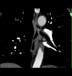 Pulmonary Embolism (PE) in Pulmonary Artery in Left Lower Lobe - CTisus CT Scan