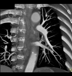 Pulmonary Embolism (PE) in Pulmonary Artery in Left Lower Lobe - CTisus CT Scan