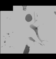 Pulmonary Embolism (PE) in Pulmonary Artery in Left Lower Lobe - CTisus CT Scan