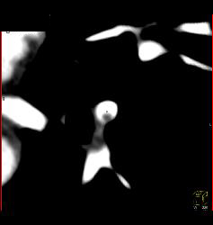 Pulmonary Embolism (PE) in Pulmonary Artery in Left Lower Lobe - CTisus CT Scan