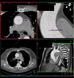 Aortic Aneurysm With Dilated Root - CTisus CT Scan