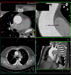 Aortic Aneurysm With Dilated Root - CTisus CT Scan