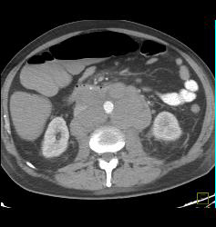 Lymphoma With Extensive Adenopathy - CTisus CT Scan