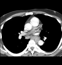 Lymphoma With Extensive Adenopathy - CTisus CT Scan