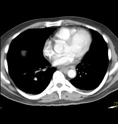 Lymphoma With Extensive Adenopathy - CTisus CT Scan