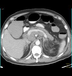 Lymphoma With Extensive Adenopathy - CTisus CT Scan