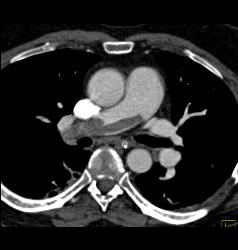 Saddle Emboli - CTisus CT Scan