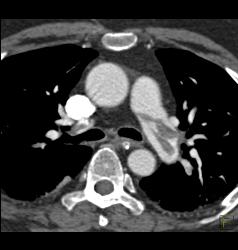 Saddle Emboli - CTisus CT Scan